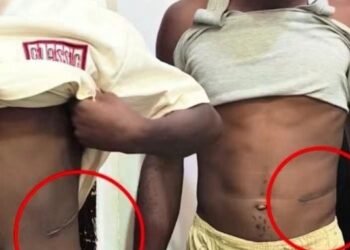 Mother Reveals How She Discovered Her Son Had Lost a Kidney
