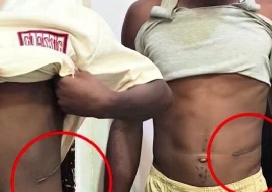 Mother Reveals How She Discovered Her Son Had Lost a Kidney